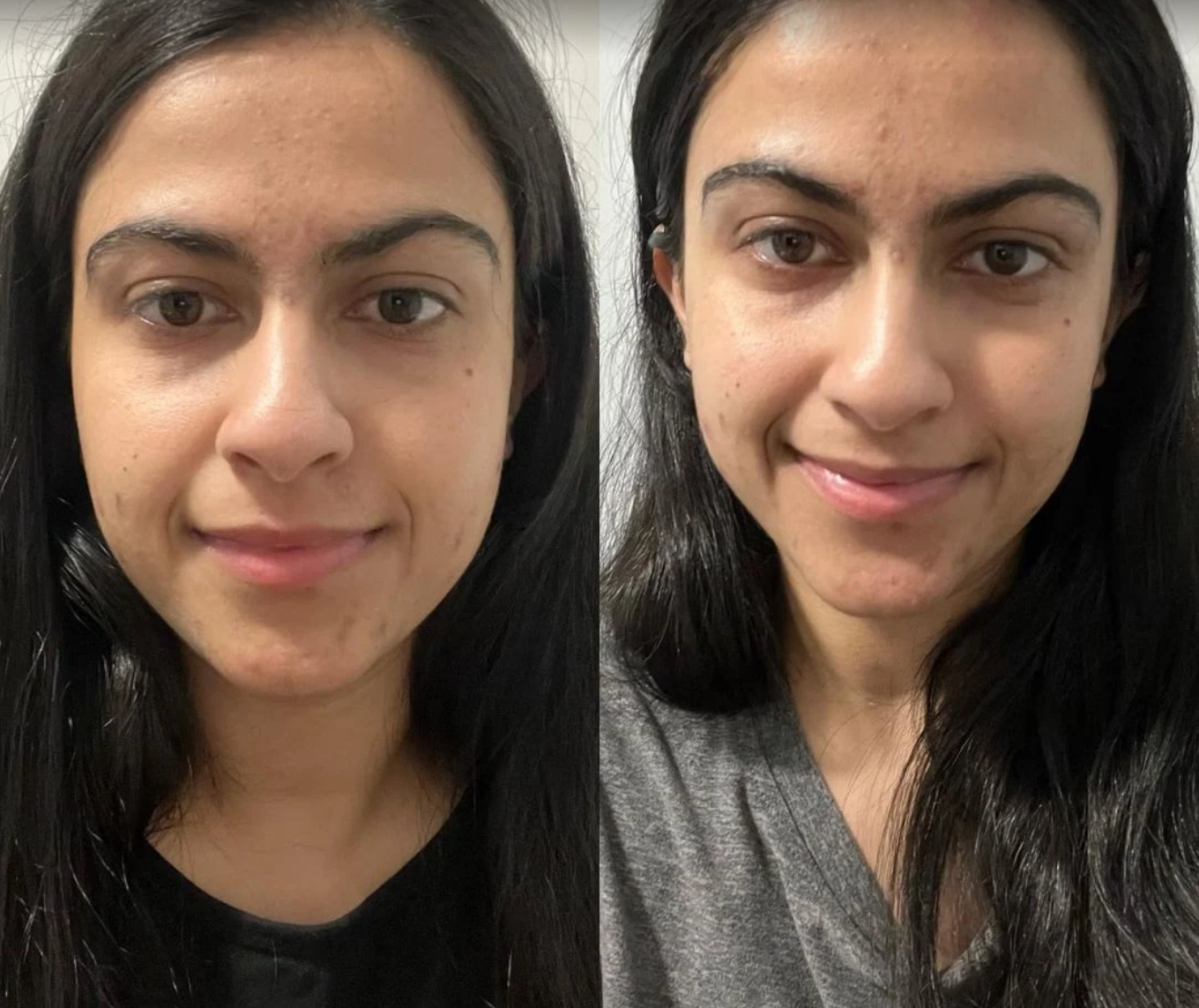 Facial Treatment Results