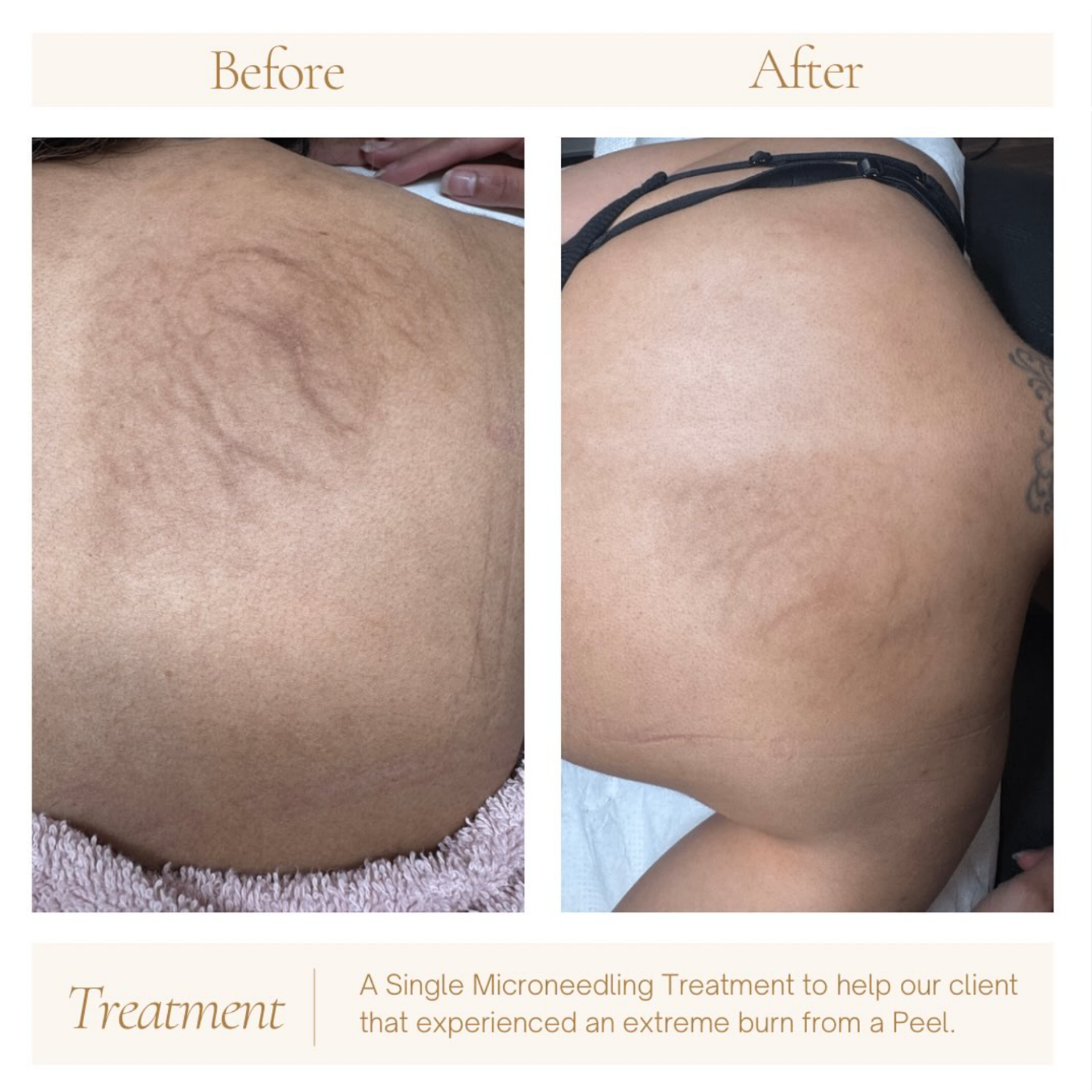 Before and after treatment results at Hebe Aesthetics Med Spa Woodbridge