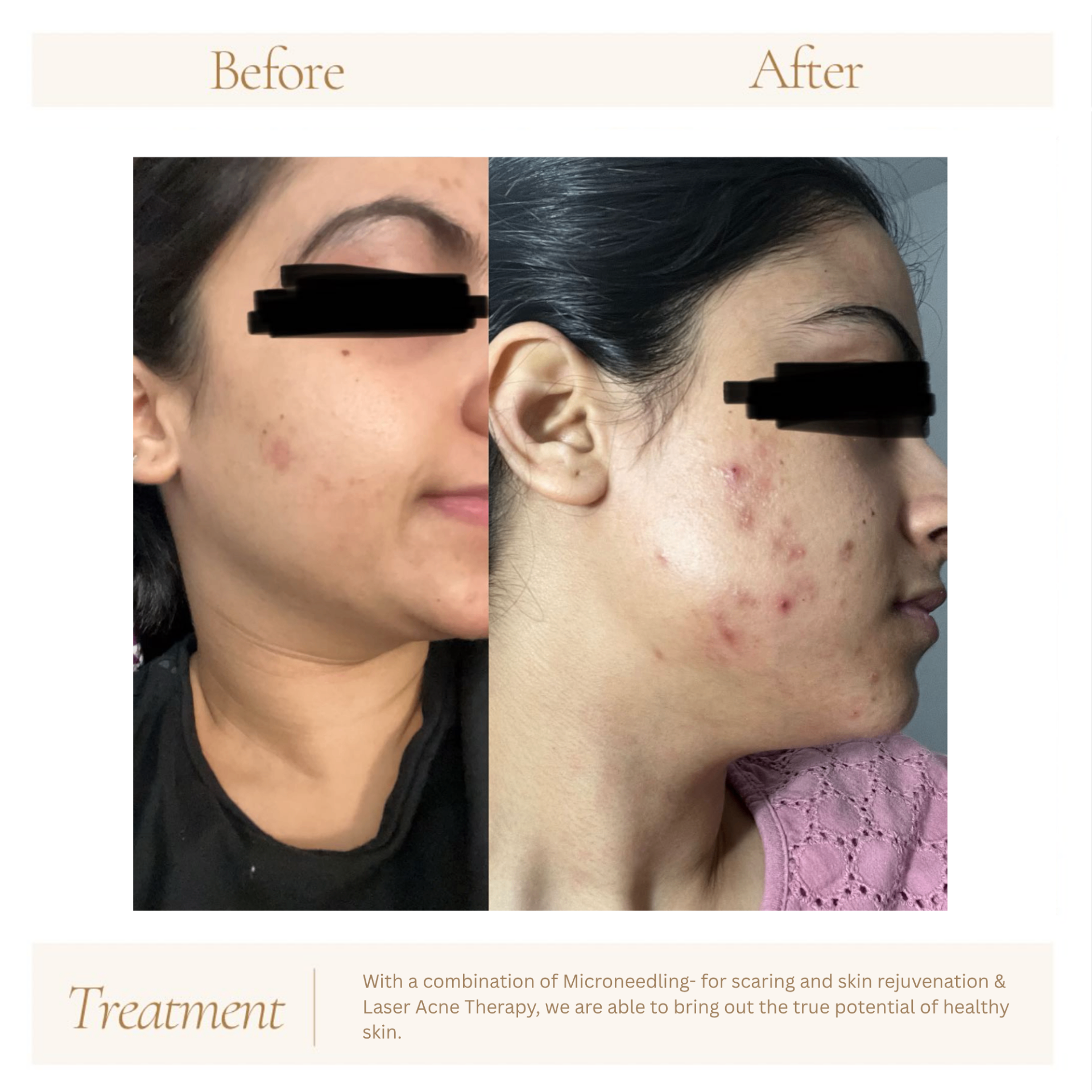 Before and after treatment results at Hebe Aesthetics Med Spa Woodbridge