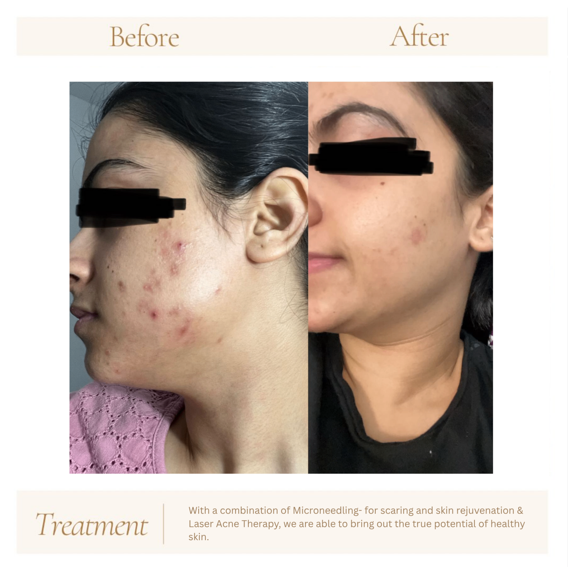 Before and after treatment results at Hebe Aesthetics Med Spa Woodbridge