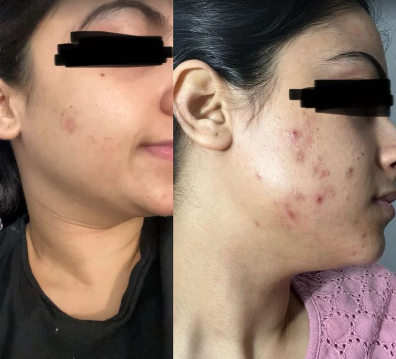 Before and After Acne Treatment Results