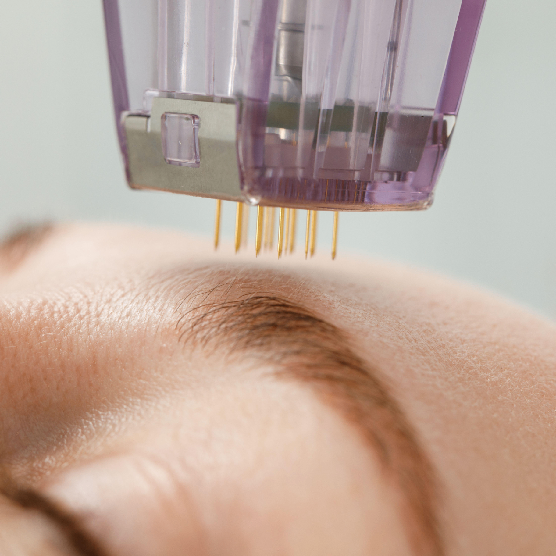 Microneedling